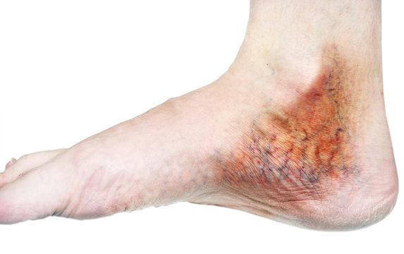 Flebite: sintomi, rischi e trattamenti