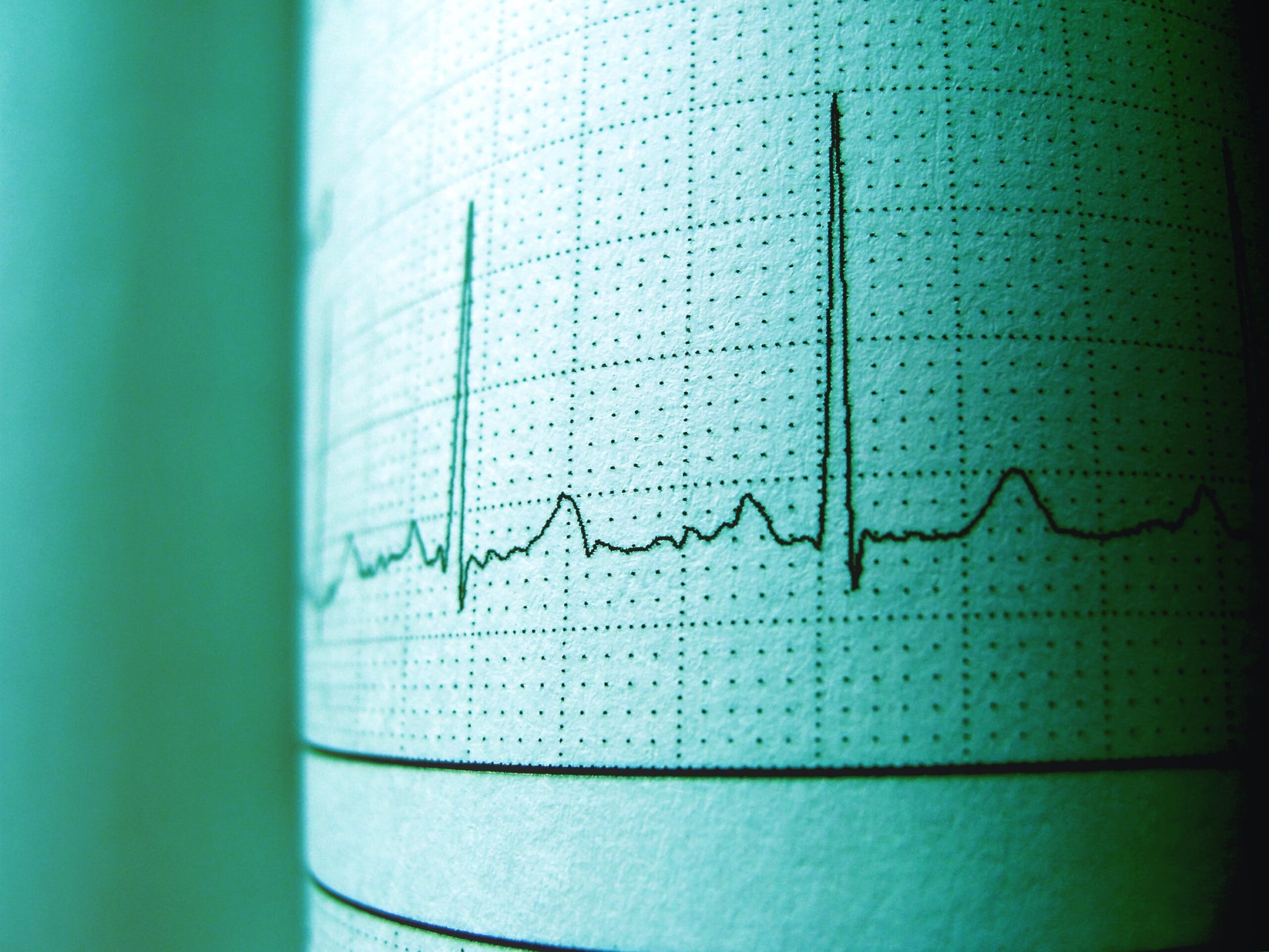 Aritmia cardiaca: cos’è e quali sono le cause