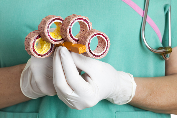 Aterosclerosi: causa, sintomi e trattamento