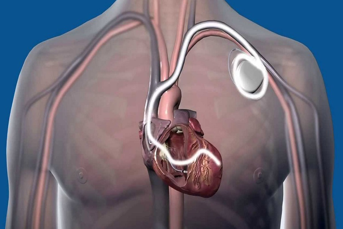 L’impianto pacemaker